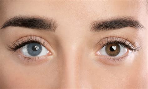 Heterochromia .